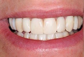 Pahrump Before and After Dental Crowns