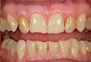 89048 Before and After Dental Implants