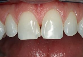 89048 Before and After Dental Implants
