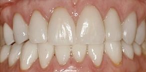 Pahrump Before and After Dental Crowns