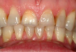 89048 Before and After Dental Implants